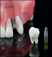 dental implants london