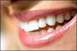 porcelain veneers